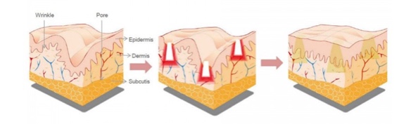 Frakcionirana radiofrekvenca